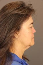 Facial Rejuvenation Before and After Photos