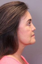 Facial Rejuvenation Before and After Photos