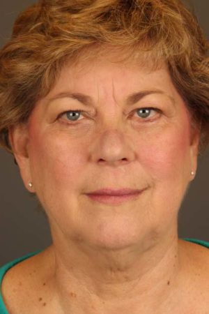 Facial Rejuvenation Before and After Photos Case 149 Before Photo Facial Rejuvenation Before and After Photos