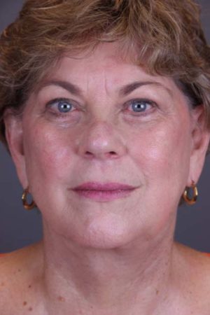 Facial Rejuvenation Before and After Photos Case 149 After Photo Facial Rejuvenation Before and After Photos