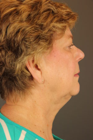 Facial Rejuvenation Before and After Photos Case 149 Before Photo Facial Rejuvenation Before and After Photos