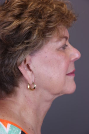 Facial Rejuvenation Before and After Photos Case 149 After Photo Facial Rejuvenation Before and After Photos