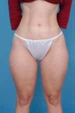 Liposuction Before and After Photos