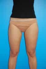 Liposuction Before and After Photos