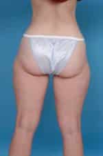 Liposuction Before and After Photos