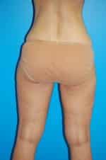 Liposuction Before and After Photos