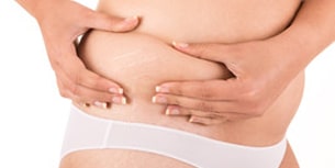 Stretch Mark Repair Charleston - Laser Skin Treatment by Dr. Sonny O