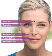 Juvederm® or Restylane Lyft