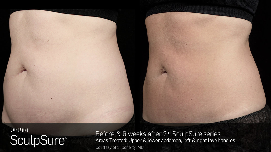 SculpSure with Dr. Sonny O