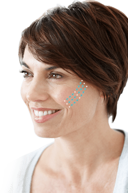 woman-threadlifts