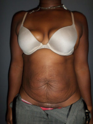 Abdominoplasty or Tummy Tuck Case 821 Before Photo Abdominoplasty or Tummy Tuck