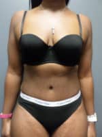 Abdominoplasty or Tummy Tuck