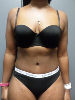 Abdominoplasty or Tummy Tuck Case 821 After Photo Abdominoplasty or Tummy Tuck