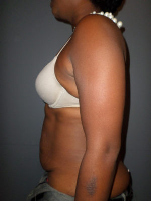 Abdominoplasty or Tummy Tuck Case 821 Before Photo Abdominoplasty or Tummy Tuck