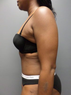 Abdominoplasty or Tummy Tuck Case 821 After Photo Abdominoplasty or Tummy Tuck