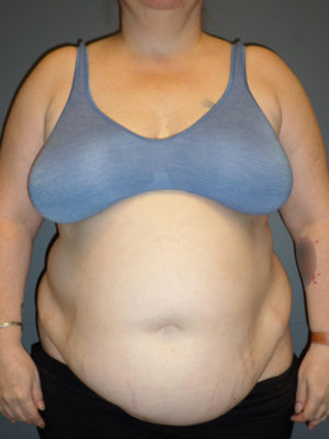 Abdominoplasty or Tummy Tuck