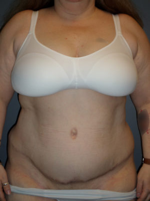 Abdominoplasty or Tummy Tuck