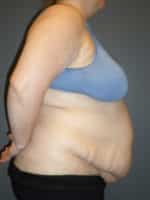 Abdominoplasty or Tummy Tuck