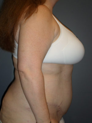 Abdominoplasty or Tummy Tuck