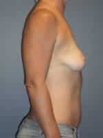 Breast Augmentation Before and After Photos