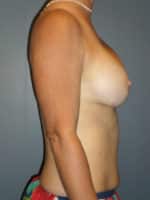 Breast Augmentation Before and After Photos