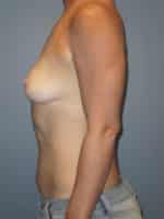 Breast Augmentation Before and After Photos