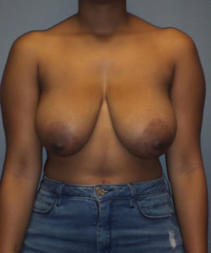 Breast Reduction and Breast Lift