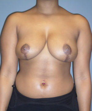 Breast Reduction and Breast Lift