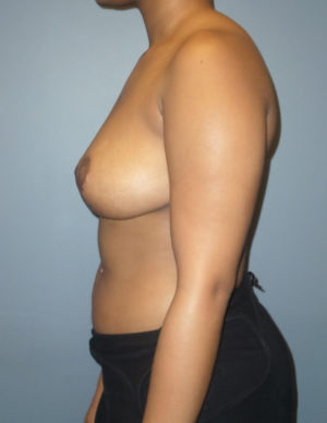 Breast Reduction and Breast Lift