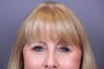 Eye Lift Before and After Photos
