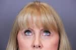 Eye Lift Before and After Photos
