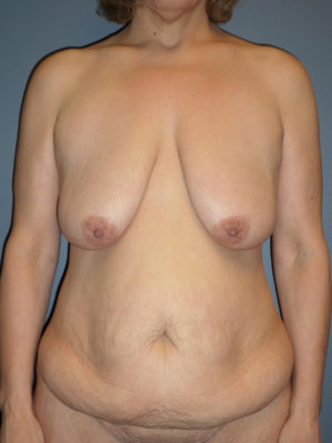Mommy Makeover Case 861 Before Photo Mommy Makeover