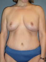 Mommy Makeover Before and After Photos