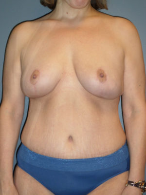 Mommy Makeover Case 861 After Photo Mommy Makeover