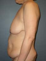 Mommy Makeover Before and After Photos