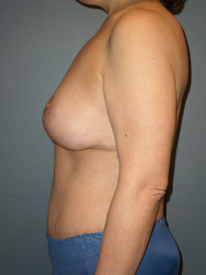 Mommy Makeover Case 861 After Photo Mommy Makeover