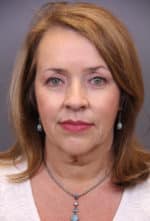 Timeless Lift Before and After Photos