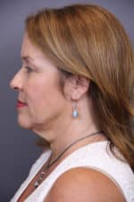 Timeless Lift Before and After Photos