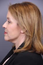 Timeless Lift Before and After Photos