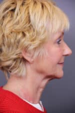 Timeless Lift Before and After Photos