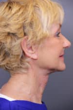 Timeless Lift Before and After Photos