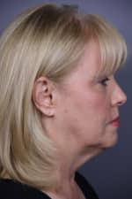 Timeless Lift Before and After Photos