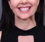 FaceTite Before and After Photos