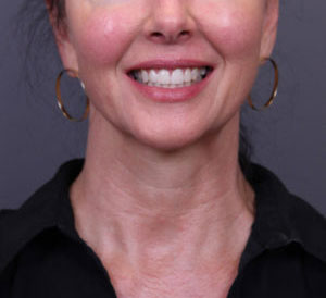 FaceTite Case 846 After Photo FaceTite