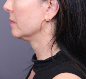 FaceTite Case 846 Before Photo FaceTite