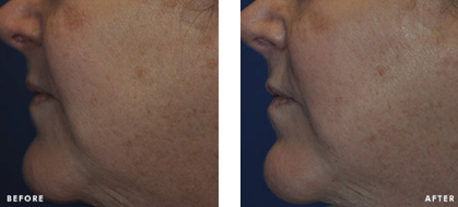 SkinCeuticals Micropeel 30 Solution Before and After Photos of woman's cheeks