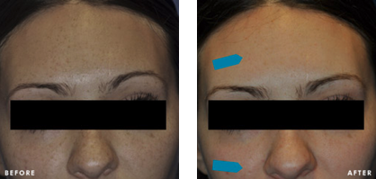 SkinCeuticals Pigment Balancing Peel Before and After Photos of woman's face